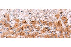 Immunohistochemistry of paraffin-embedded Human liver cancer tissue using NCAN Polyclonal Antibody at dilution of 1:30(x200) (Neurocan Antikörper)