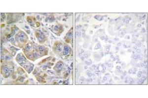 Immunohistochemistry analysis of paraffin-embedded human breast carcinoma tissue, using Integrin beta4 (Ab-1510) Antibody.