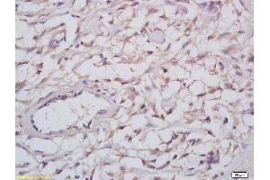 Formalin-fixed and paraffin embedded human cervical carcinoma labeled with Anti-Nogo A+B Polyclonal Antibody, Unconjugated  at 1:200 followed by conjugation to the secondary antibody and DAB staining (Reticulon 4 Antikörper  (AA 251-357))