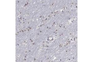 Immunohistochemical staining (Formalin-fixed paraffin-embedded sections) of human lateral ventricle with SOX11 polyclonal antibody  shows nuclear positivity in glial cells at 1:200 - 1:500 dilution. (SOX11 Antikörper)