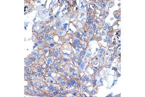 Immunohistochemistry of paraffin-embedded human lung cancer using Talin 2 Rabbit mAb (ABIN7270720) at dilution of 1:100 (40x lens). (TLN2 Antikörper)