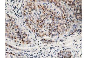 Immunohistochemical staining of paraffin-embedded Carcinoma of Human pancreas tissue using anti-HOXC11 mouse monoclonal antibody. (HOXC11 Antikörper)