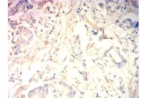 Immunohistochemical analysis of paraffin-embedded human stomach cancer tissues using MB mouse mAb with DAB staining. (Myoglobin Antikörper  (AA 2-154))