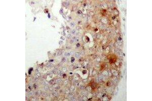 Immunohistochemical analysis of XIAP (pS87) staining in human prostate cancer formalin fixed paraffin embedded tissue section. (XIAP Antikörper  (pSer87))