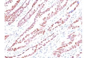 Formalin-fixed, paraffin-embedded human Colon Carcinoma stained with p57 Monoclonal Antibody (KP10). (CDKN1C Antikörper)