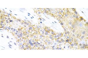Immunohistochemistry of paraffin-embedded Human esophageal cancer using PPP2R4 Polyclonal Antibody at dilution of 1:200 (40x lens). (PPP2R4 Antikörper)
