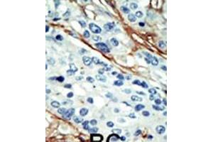 Formalin-fixed and paraffin-embedded human cancer tissue reacted with the primary antibody, which was peroxidase-conjugated to the secondary antibody, followed by DAB staining. (NUAK1 Antikörper  (C-Term))