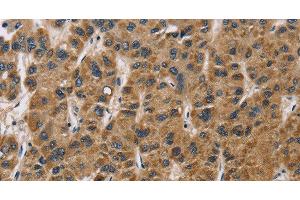 Immunohistochemistry of paraffin-embedded Human liver cancer tissue using IL19 Polyclonal Antibody at dilution 1:40 (IL-19 Antikörper)