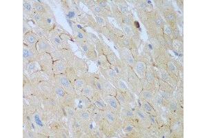 Immunohistochemistry of paraffin-embedded Human liver cancer using CEACAM7 Polyclonal Antibody at dilution of 1:100 (40x lens). (CEACAM7 Antikörper)