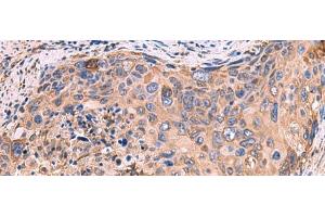 Immunohistochemistry of paraffin-embedded Human cervical cancer tissue using GUSB Polyclonal Antibody at dilution of 1:50(x200) (Glucuronidase beta Antikörper)