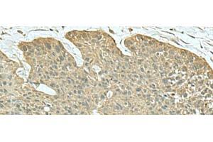 Immunohistochemistry of paraffin-embedded Human esophagus cancer tissue using FN3KRP Polyclonal Antibody at dilution of 1:55(x200) (FN3KRP Antikörper)