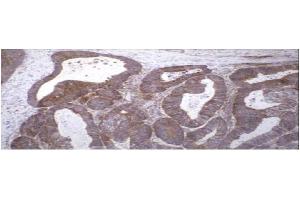 Immunohistochemical staining of human colon carcinoma tissue using TIMP-2 antibody . (TIMP2 Antikörper)