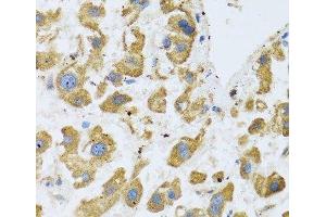 Immunohistochemistry of paraffin-embedded Human liver cancer using BTD Polyclonal Antibody at dilution of 1:100 (40x lens). (BTD Antikörper)