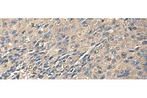 Immunohistochemistry of paraffin-embedded Human liver cancer tissue using ZG16 Polyclonal Antibody at dilution of 1:95(x200) (ZG16 Antikörper)