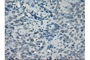 Immunohistochemical staining of paraffin-embedded Carcinoma of bladder tissue using anti-PORmouse monoclonal antibody. (POR Antikörper)