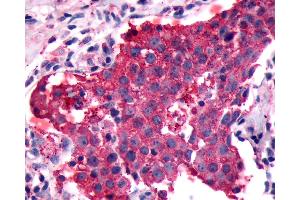 Anti-PGR1 / GPR153 antibody IHC of human Breast, Carcinoma. (GPR153 Antikörper  (Extracellular Domain))