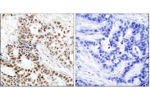 Immunohistochemical analysis of paraffin-embedded human breast carcinoma tissue, using BRCA1 (phospho-Ser1423) antibody (E011242). (BRCA1 Antikörper  (pSer1423))