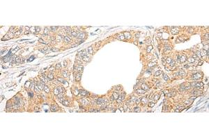 Immunohistochemistry of paraffin-embedded Human gastric cancer tissue using CCL5 Polyclonal Antibody at dilution of 1:50(x200)