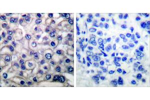 Peptide - +Immunohistochemical analysis of paraffin-embedded human breast carcinoma tissue using EGFR (Ab-693) antibody (#B0009). (EGFR Antikörper  (Thr693))