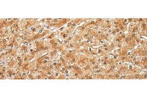 Immunohistochemistry of paraffin-embedded Human liver cancer tissue using DRD3 Polyclonal Antibody at dilution of 1:25(x200) (DRD3 Antikörper)