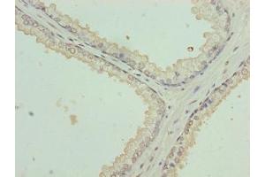 Immunohistochemistry of paraffin-embedded human prostate cancer using ABIN7157364 at dilution of 1:100 (Keratin 35 Antikörper  (AA 1-455))