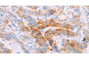 Immunohistochemistry of paraffin-embedded Human thyroid cancer using MAP4K3 Polyclonal Antibody at dilution of 1:30 (MAP4K3 Antikörper)