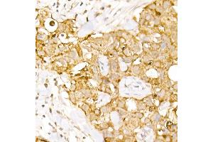 Immunohistochemistry of paraffin-embedded human breast cancer using B1 Rabbit pAb (ABIN6129916, ABIN6136962, ABIN6136963 and ABIN6222795) at dilution of 1:150 (40x lens). (AP3B1 Antikörper  (AA 895-1094))