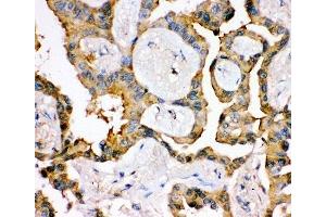 IHC-P: IRS1 antibody testing of human lung cancer tissue