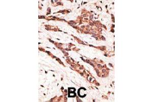 Formalin-fixed and paraffin-embedded human cancer tissue reacted with LPAR2 polyclonal antibody  , which was peroxidase-conjugated to the secondary antibody, followed by AEC staining. (EDG4 Antikörper  (N-Term))