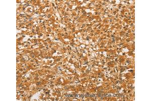 Immunohistochemistry of Human colon cancer using BCL2L14 Polyclonal Antibody at dilution of 1:40 (BCL2L14 Antikörper)