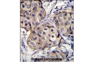 CBLN2 Antibody (C-term) (ABIN655780 and ABIN2845215) immunohistochemistry analysis in formalin fixed and paraffin embedded human breast carcinoma followed by peroxidase conjugation of the secondary antibody and DAB staining. (CBLN2 Antikörper  (C-Term))