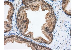 Immunohistochemical staining of paraffin-embedded Adenocarcinoma of Human ovary tissue using anti-TACC3 mouse monoclonal antibody. (TACC3 Antikörper)