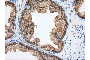 Immunohistochemical staining of paraffin-embedded Adenocarcinoma of Human ovary tissue using anti-TACC3 mouse monoclonal antibody.
