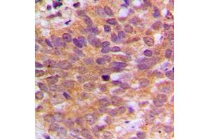 Immunohistochemical analysis of ABL1 staining in human breast cancer formalin fixed paraffin embedded tissue section. (ABL1 Antikörper  (C-Term))