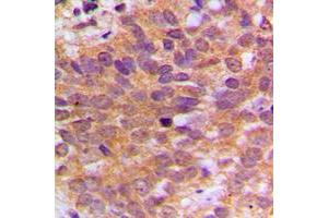 Immunohistochemical analysis of ABL1 staining in human breast cancer formalin fixed paraffin embedded tissue section.