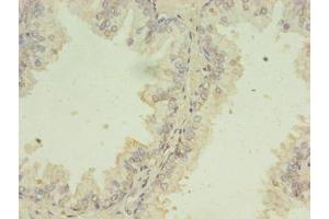 Immunohistochemistry of paraffin-embedded human prostate cancer using ABIN7174153 at dilution of 1:100 (SNRPB2 Antikörper  (AA 1-225))