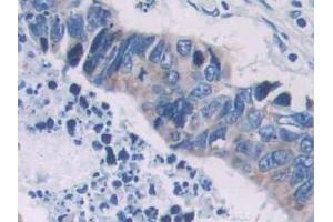 IHC-P analysis of Human Colorectal cancer Tissue, with DAB staining. (PCOLCE Antikörper  (AA 315-437))