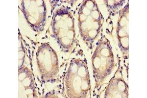 Immunohistochemistry of paraffin-embedded human colon cancer using ABIN7175909 at dilution of 1:100 (XPNPEP1 Antikörper  (AA 2-623))