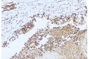 ABIN6275463 at 1/100 staining Human lung cancer tissue by IHC-P.