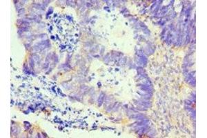 Immunohistochemistry of paraffin-embedded human ovarian cancer using ABIN7157975 at dilution of 1:100 (Leiomodin 1 Antikörper  (AA 29-187))