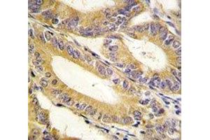 IHC analysis of FFPE human colon carcinoma tissue stained with XIAP antibody (XIAP Antikörper  (AA 1-30))