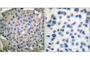 Immunohistochemistry analysis of paraffin-embedded human breast carcinoma, using Cortactin (Phospho-Tyr466) Antibody. (Cortactin Antikörper  (pTyr466))