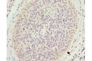 Immunohistochemistry of paraffin-embedded human cervical cancer using ABIN7158965 at dilution of 1:100 (Mammaglobin A Antikörper  (AA 1-93))