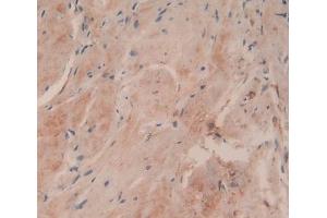 IHC-P analysis of Human Breast Cancer Tissue, with DAB staining. (COL6a3 Antikörper  (AA 463-624))
