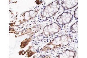 ABIN6267473 at 1/200 staining human colon cancer tissue sections by IHC-P. (AKT1 Antikörper  (pThr308))