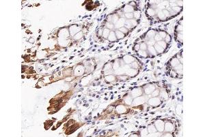 ABIN6267473 at 1/200 staining human colon cancer tissue sections by IHC-P.