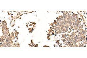 Immunohistochemistry of paraffin-embedded Human lung cancer tissue using SOX3 Polyclonal Antibody at dilution of 1:50(x200) (SOX3 Antikörper)