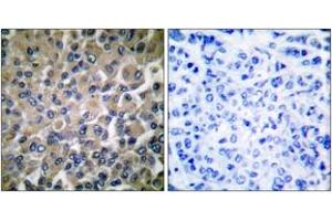 Immunohistochemistry analysis of paraffin-embedded human breast carcinoma tissue, using GRP78 Antibody.