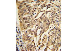 Formalin-fixed and paraffin-embedded human lung carcinoma with SAR1A Antibody (Center), which was peroxidase-conjugated to the secondary antibody, followed by DAB staining. (SAR1A Antikörper  (AA 122-149))