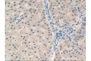 IHC-P analysis of Human Liver Cancer Tissue, with DAB staining. (Retinol Binding Protein 5 Antikörper  (AA 2-135))